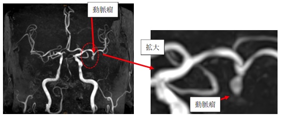 左中大脳動脈瘤(MCA) 
