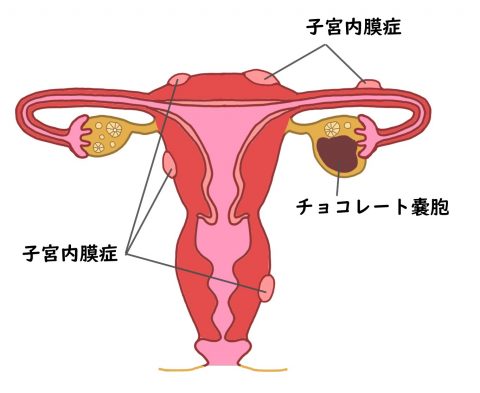 子宮内膜症の説明