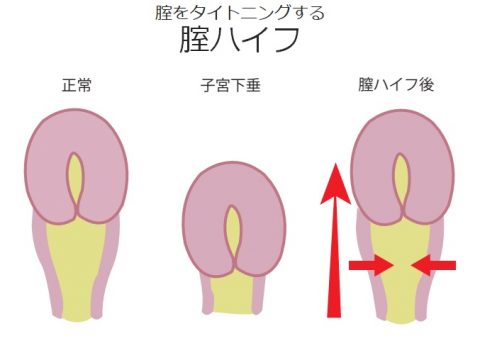 膣をタイトニングする膣ハイフ