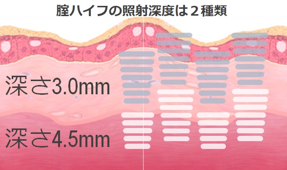 腟ハイフの照射深度は２種類