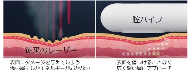 腟ハイフと従来のレーザーの比較図