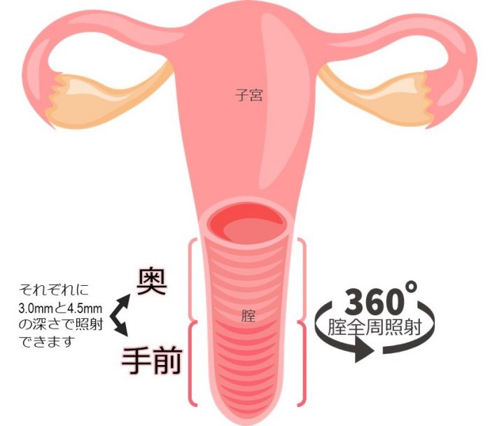 膣の奥と手前、全周照射