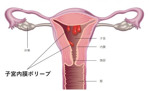 子宮内膜ポリープ