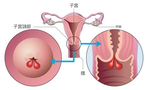 頸管ポリープ