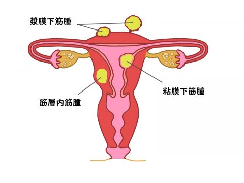 子宮筋腫の種類