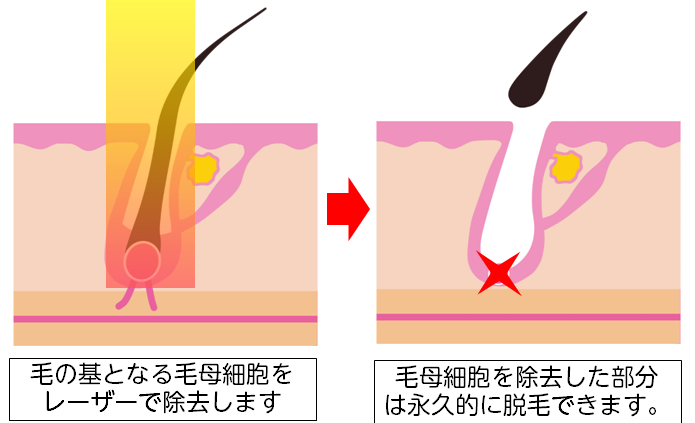 名古屋市昭和区いりなかで医療レーザー脱毛器を用いた全身医療脱毛を提供しているいりなか駅前皮フ科ビューティークリニックの医療脱毛の仕組み 